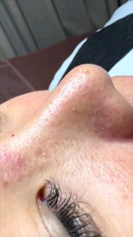 #kìmbấm #kìmbạmmụn #mụn #điềutrịmụn #FYP #Shopee #đồhot